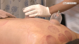 外國人瘋來台「拔罐.刮痧」　整復師籲每週1次為限