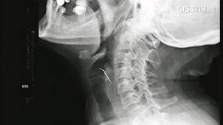 秘魯女子誤食鐵釘　劃破頸動脈吐血險送命