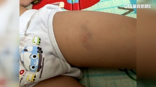 童腿瘀青稱「老師捏的」　師駁斥　園方：若不適任解聘