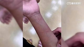 有毒！高雄沿海現「僧帽水母」　多童遭螫傷就醫