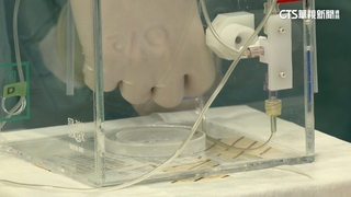 透過「釔90」將肝腫瘤縮小.降期　提高患者存活率