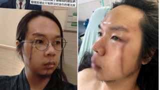 願免費幫「英雄長髮哥」除疤！　編哥：醫美團隊全力配合