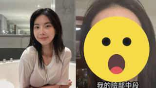 因臉部蜂窩性組織炎「腫到鼻子變形」　奎丁：差點登出這個世界