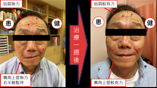 71歲男一早刷牙竟「顏面神經麻痺」 靠中醫針灸改善情況 | 華視新聞