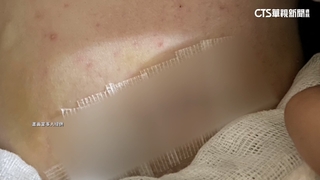 乳房腫瘤開刀「搞錯位置」？女淚崩　醫院：遵循醫療常規
