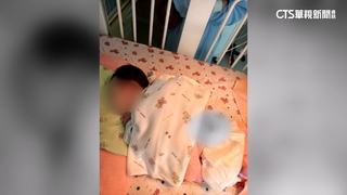 控月子中心消極釀孩尿布疹.血便　　醫師：食物蛋白過敏