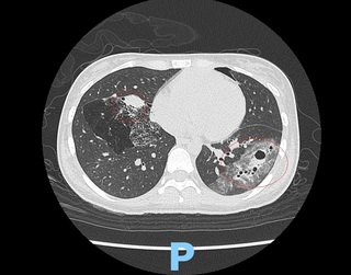 16年祕密！少女意外出車禍　竟查出先天肺部呼吸道畸形