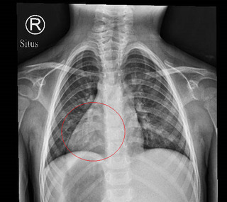 現實版「鏡面人」！3歲女童心臟長右側　機率小於萬分之一