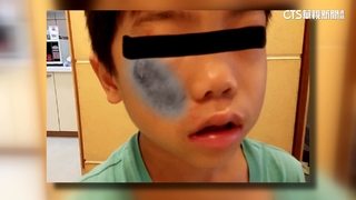 學校前「補丁爛路」害童摔破相　母怒：學區路那麼爛