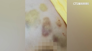 婦住安養院「多處瘀青」　家屬控虐　院方：自己撞的