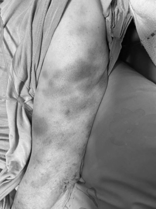 阿嬤虛弱稱「救我，外勞掐我」 家屬掀衣竟渾身傷 怒報警