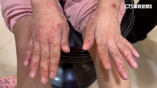 逾300班級停課　　腸病毒單週破2萬人創10年新高