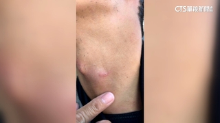 驚！　潛水教練遇釣魚鉤刺脖　潛水客籲：海域劃分