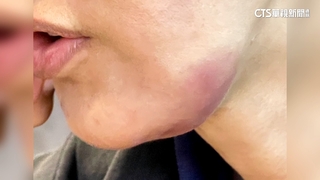 控高大競賽改規則害「撞斷下巴」　女怒提國賠