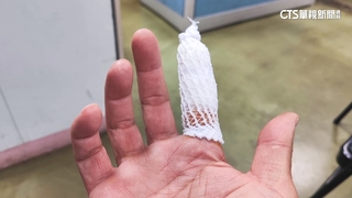 掃除遭玻璃刺傷！　手痛月餘就醫才知「碎片未清乾淨」