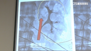 「隱性高血壓」心悸+臉潮紅　新技術3D定位！成功率高