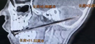 中國6歲童吃麥芽糖時摔倒　竹籤貫穿顱底深入小腦