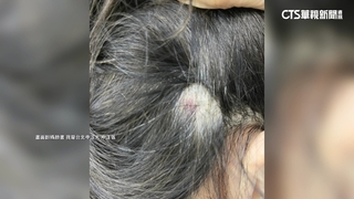 婦北市南昌公園休息遭不明物擊中頭　警方積極偵辦