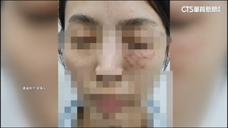 車模打牛奶針後喪命！　名醫再遭控「打電波」害灼傷