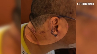 高雄流浪狗攻擊非首起　上月1男被咬傷住院