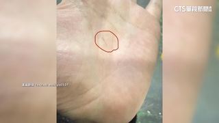 機車坐墊被放針頭　騎士扎傷憂感染急赴醫院檢查