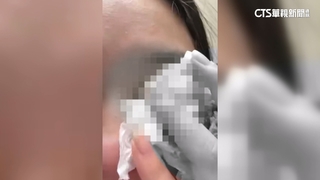 恐怖情人求復合狂騷擾　男暴打前女友害左眼失明