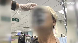 跌倒撞路燈基座！　婦臉受傷縫針　批設計太危險