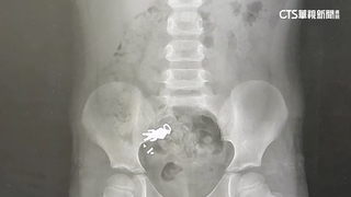 宜蘭童誤食「超人公仔」照X光現身！　網歪樓：附身合體