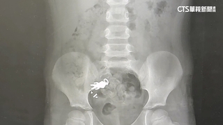 超人力霸王「任務完成」　宜蘭童誤吞吊飾最新照曝光