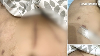 微創手術「子宮.靜脈被刺破」　女控醫療疏失.院方：配合調解