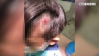 人行道機車貨架鐵片突出　4歲童額頭濺血縫4針