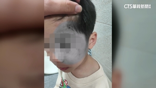 公園溜滑梯連環撞！　童臉擦傷引發安全隱憂