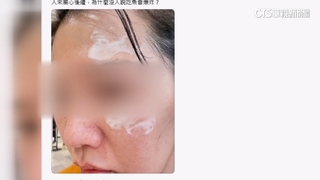 控餐廳清蒸魚爆炸燙傷臉無人聞問　業者：致電4次關心