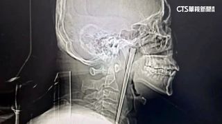 中國男子誤吞12公分金屬筷　怕開刀竟忍受卡咽部8年
