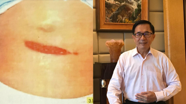 319槍擊案22週年！陳水扁PO「11cm傷口照」嘆：阿扁永遠的痛 | 華視新聞