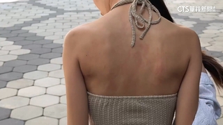 旅客控住飯店害過敏未賠償　業者：無蟲跡.恐洗劑引起